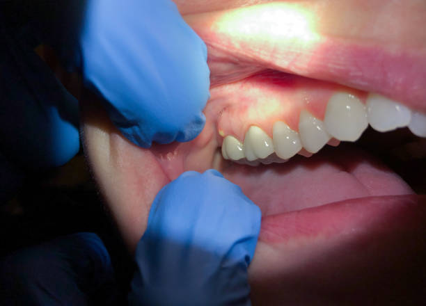 Best Emergency Treatment for Oral Infections in The Homesteads, TX